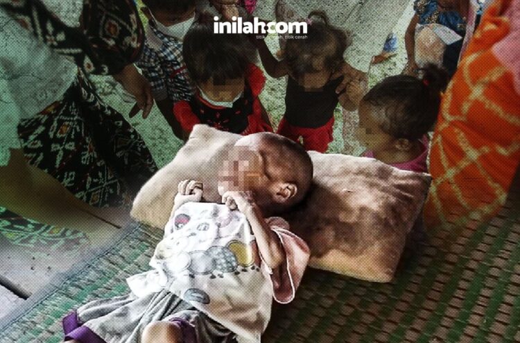 Fakta, Satu dari Lima anak di NTT Masih Mengalami Stunting